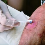 Exploring Advanced Treatments for Diabetic Wound Care