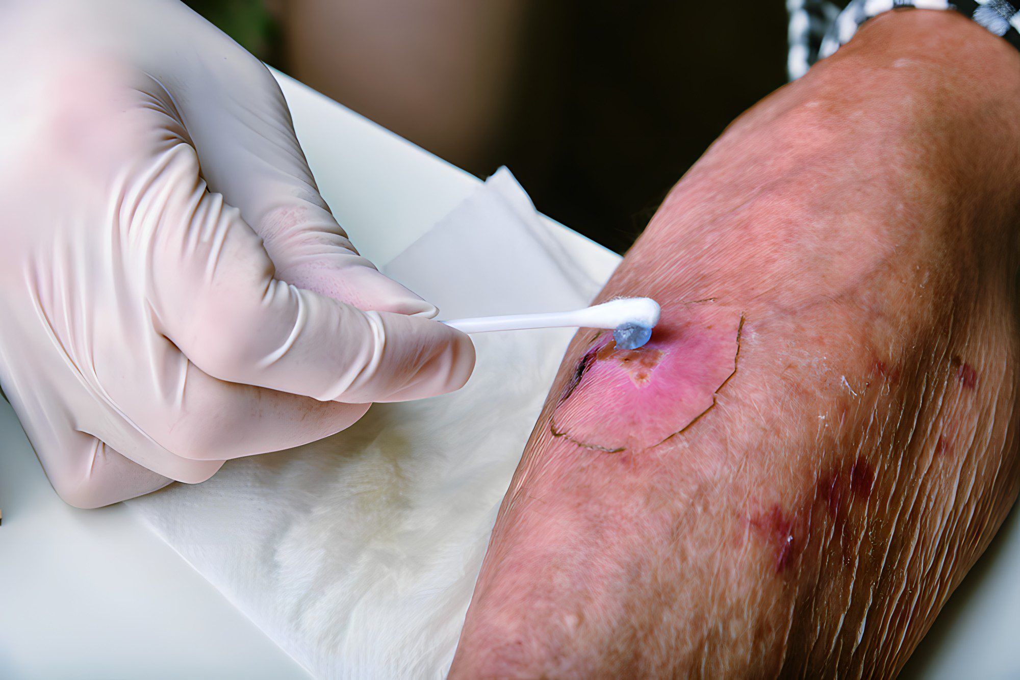 Exploring Advanced Treatments for Diabetic Wound Care