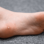How Do I Get Rid of Warts?