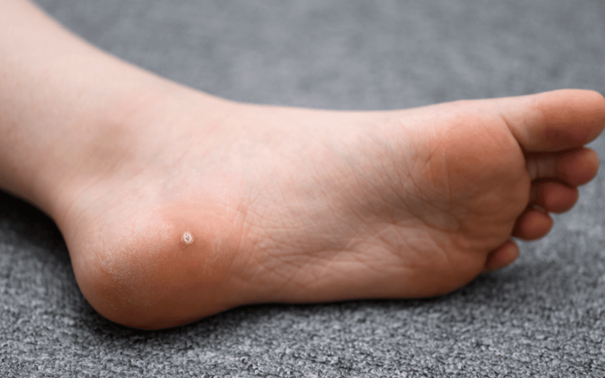 How Do I Get Rid of Warts?