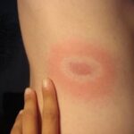 Symptoms of Lyme Disease