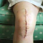 The Recovery Process After Joint Replacement Surgery