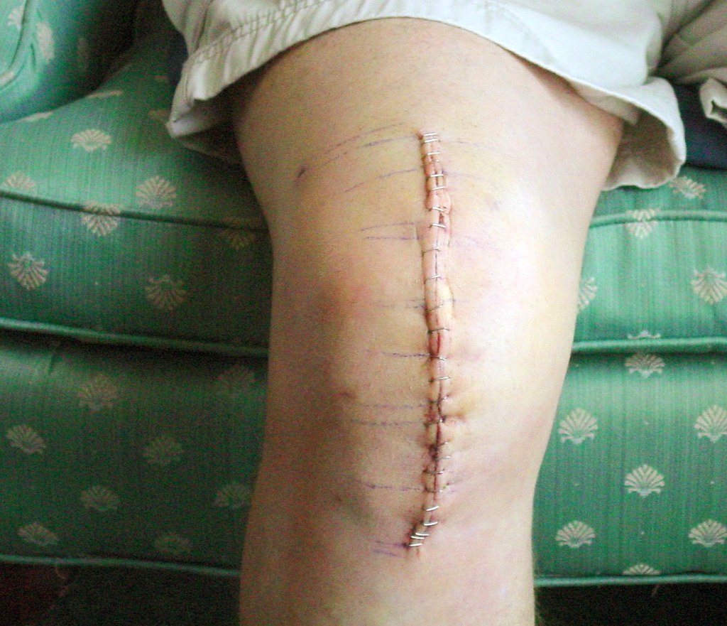 The Recovery Process After Joint Replacement Surgery