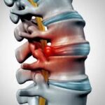 The Role of Disc Surgery in Treating Degenerative Disc Disease