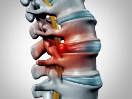 The Role of Disc Surgery in Treating Degenerative Disc Disease