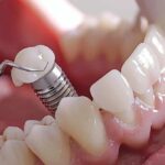 The Importance of Choosing an Experienced Implant Specialist