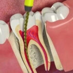 What Is the Process of Getting Endodontic Implants?