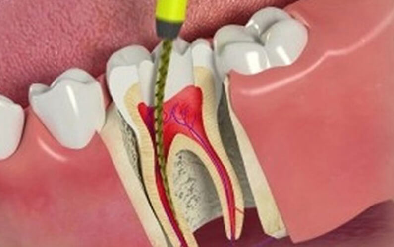 What Is the Process of Getting Endodontic Implants?