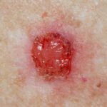 The Link Between Basal Cell Carcinoma and Skin Cancer
