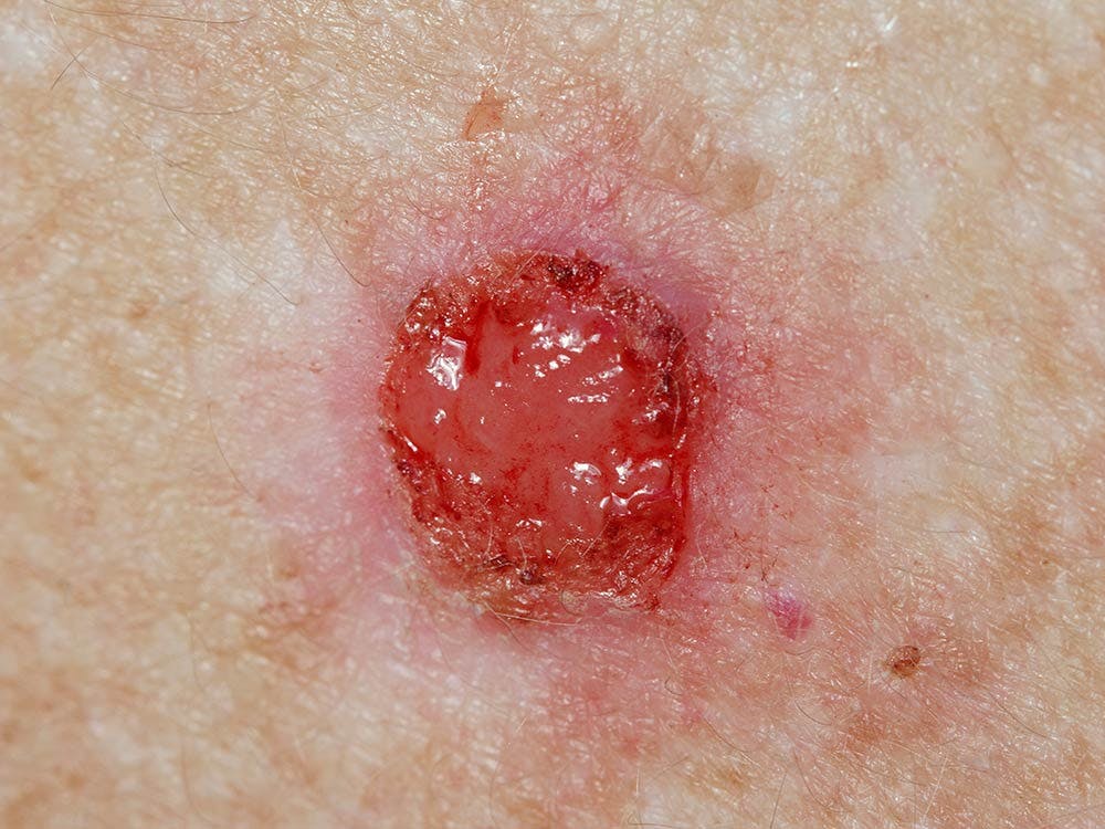The Link Between Basal Cell Carcinoma and Skin Cancer