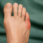 The Role of Footwear in Managing Bunions