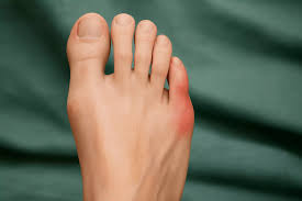 The Role of Footwear in Managing Bunions