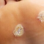 How Foot Fungus Can Affect Your Overall Well-Being