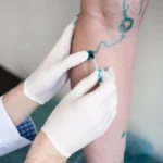How Varithena Transforms Varicose Vein Treatment