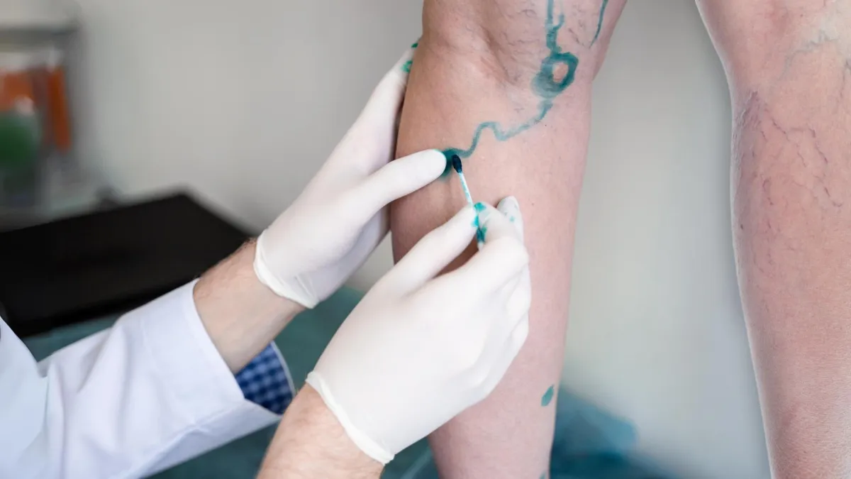 How Varithena Transforms Varicose Vein Treatment